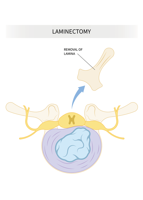 Laminectomy-intro