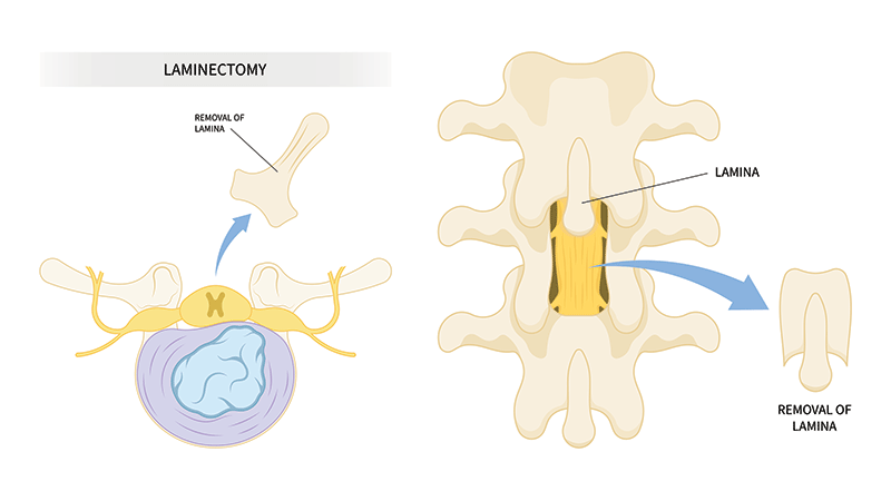 https://www.spinecaresg.com/wp-content/uploads/2023/04/Laminectomy-procedure-full.png
