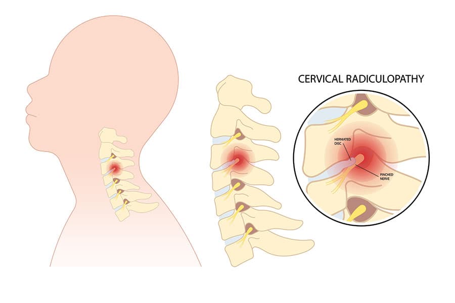 https://www.spinecaresg.com/wp-content/uploads/2023/04/cervical-radiculopathy-diagram1.jpg