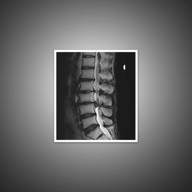 Degenerative Disc Disease SpineCare Singapore