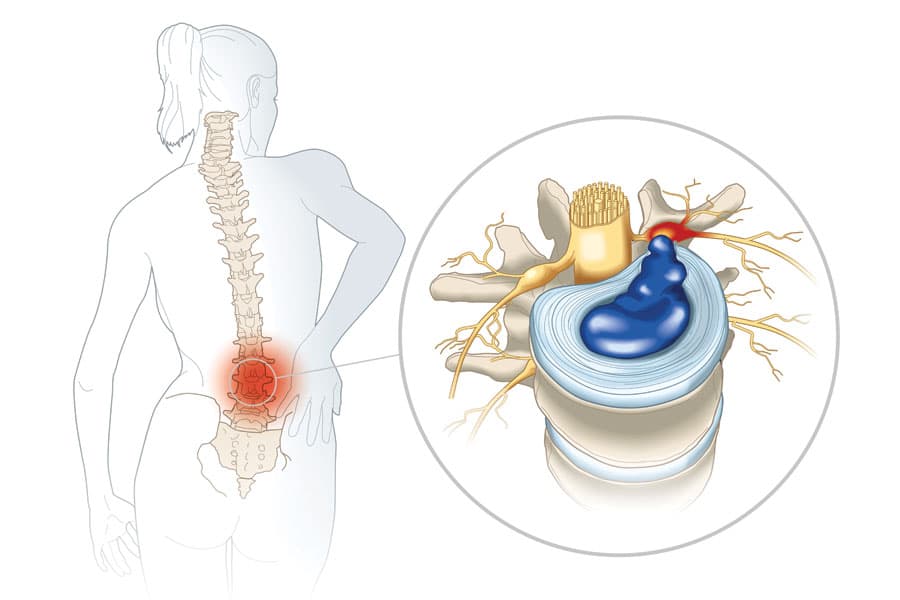 https://www.spinecaresg.com/wp-content/uploads/2023/04/herniated-disc-diagram-1.jpg