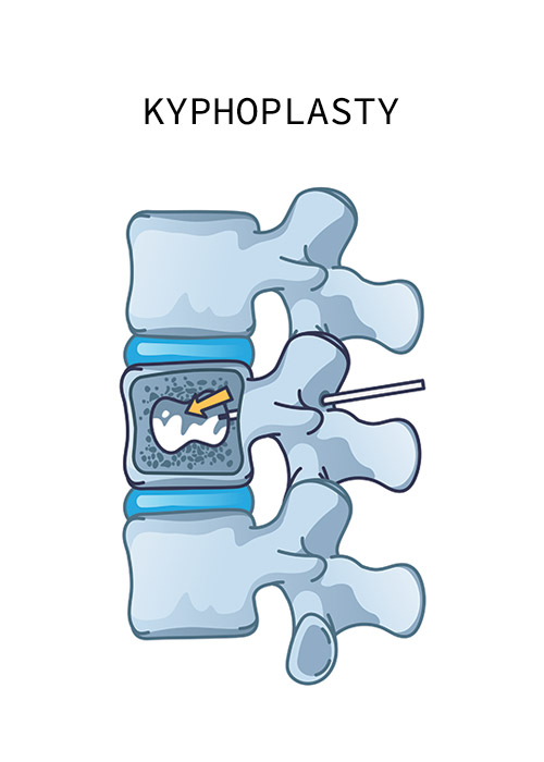 kyphoplasty-intro