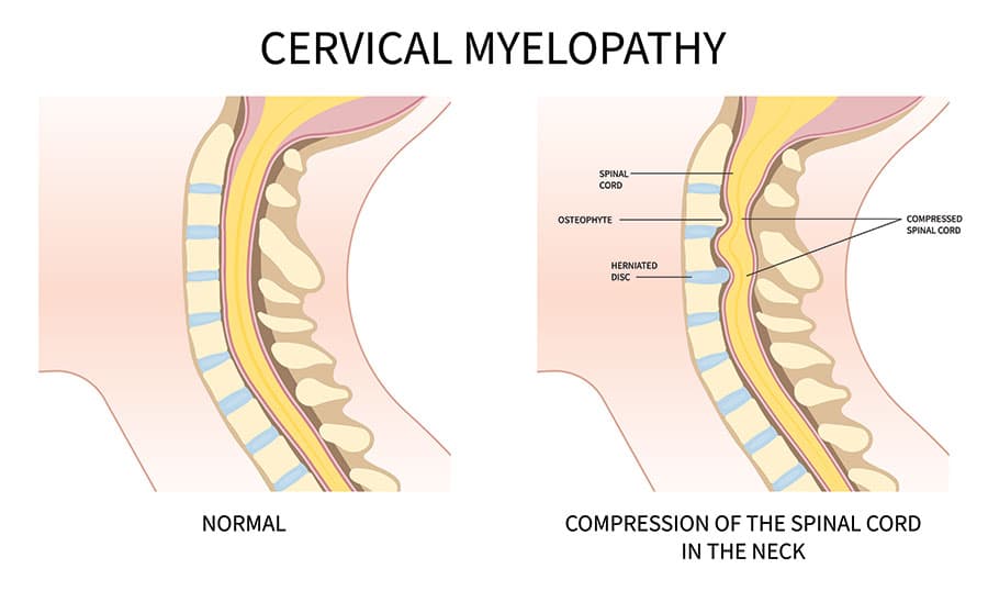 myelopathy-diagram https://www.spinecaresg.com/wp-content/uploads/2023/04/myelopathy-diagram.jpg