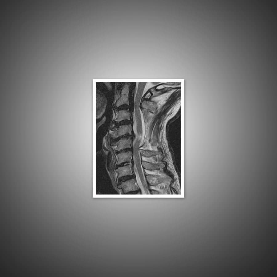 myelopathy-xray https://www.spinecaresg.com/wp-content/uploads/2023/04/myelopathy-xray.jpg