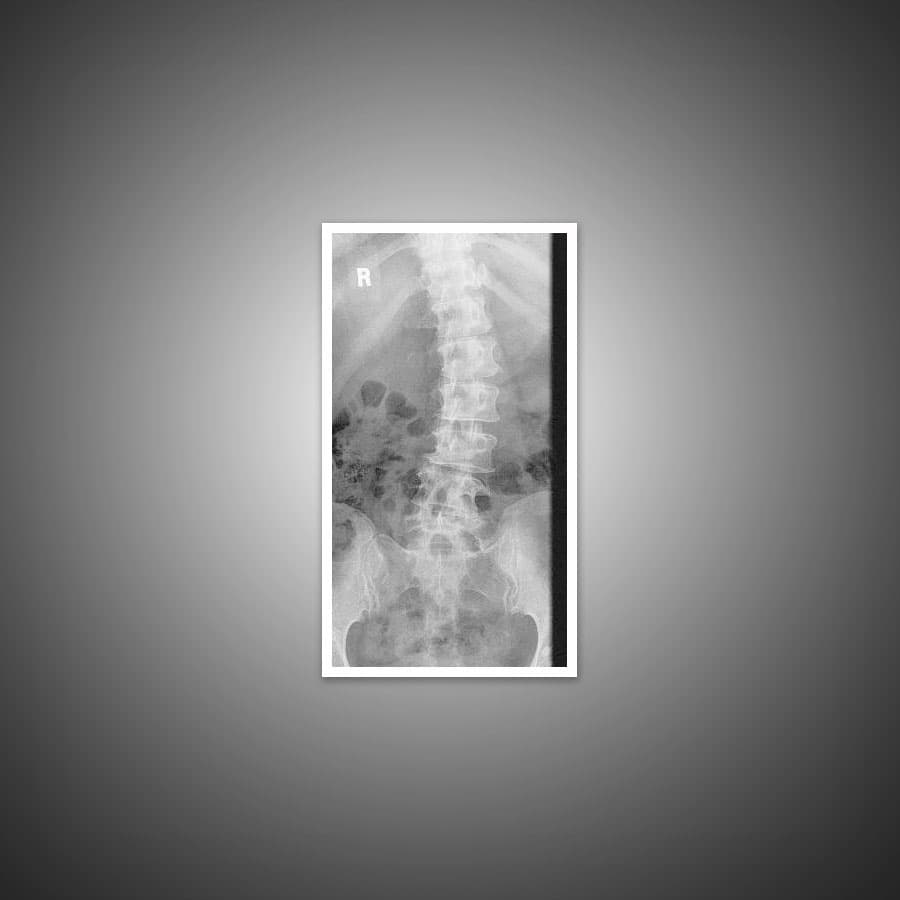 https://www.spinecaresg.com/wp-content/uploads/2023/04/scoliosis-xray-2.jpg