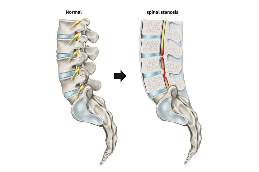 https://www.spinecaresg.com/wp-content/uploads/2023/04/spinal-stenosis-diagram.jpg