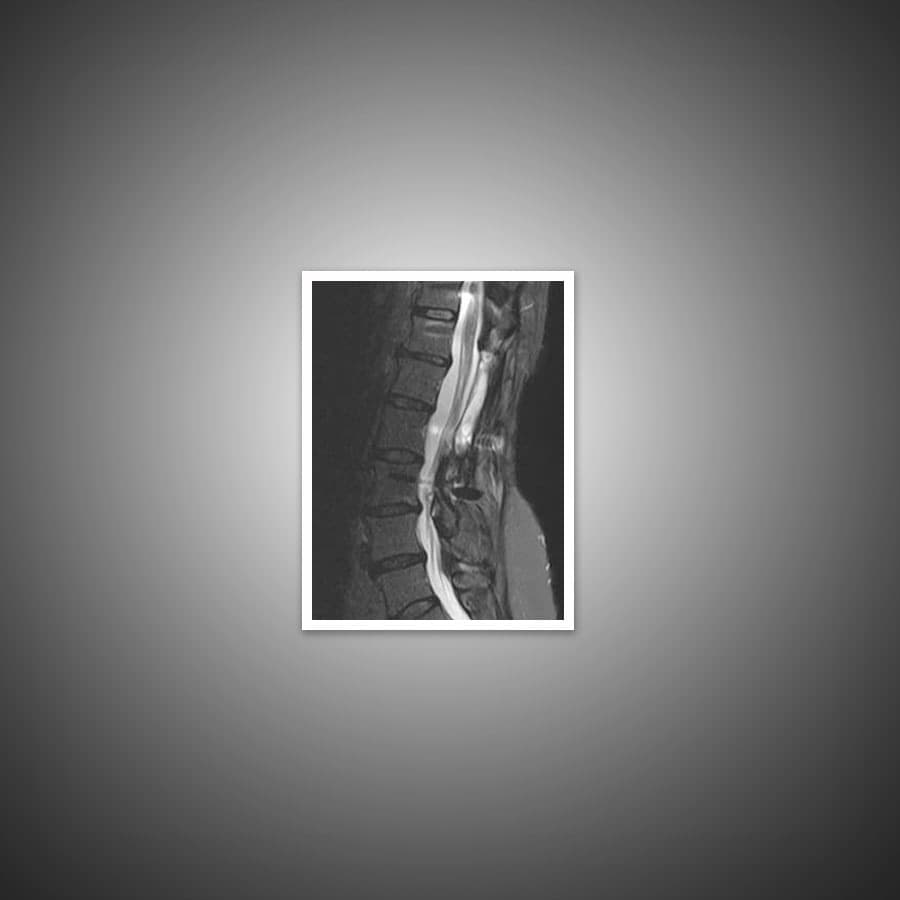 spinal-tumors-xray https://www.spinecaresg.com/wp-content/uploads/2023/04/spinal-tumors-xray.jpg