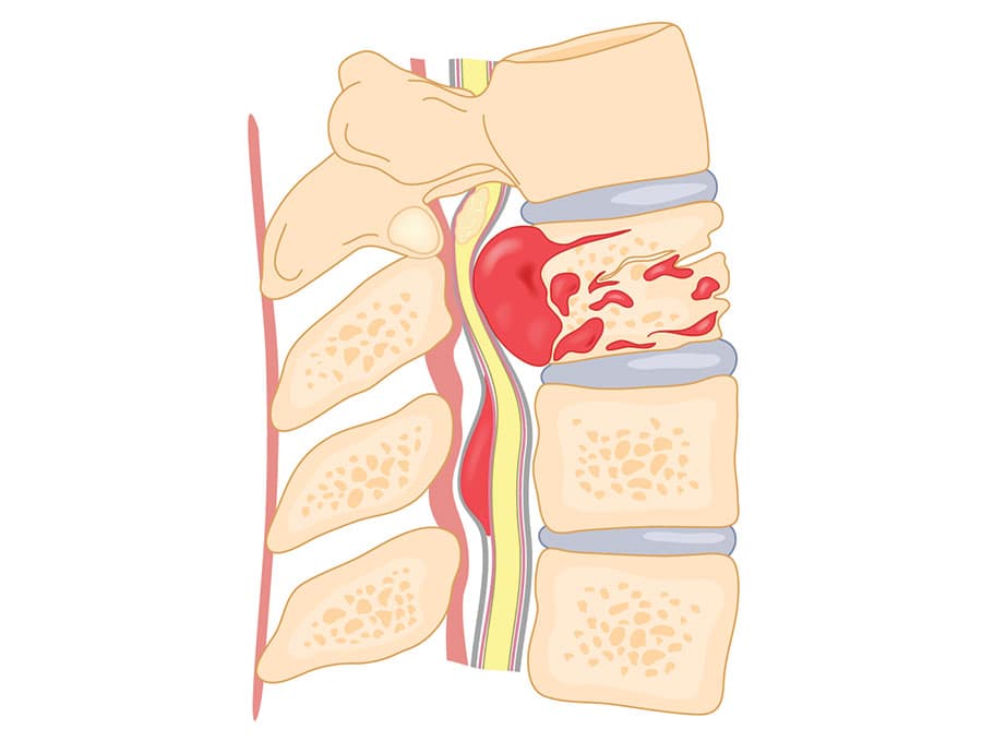 spinal-tumours-diagram https://www.spinecaresg.com/wp-content/uploads/2023/04/spinal-tumours-diagram.jpg