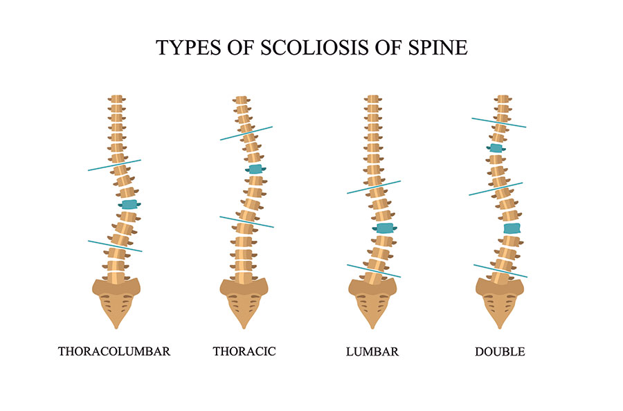 https://www.spinecaresg.com/wp-content/uploads/2023/04/types-of-scoliosis-diagram.jpg