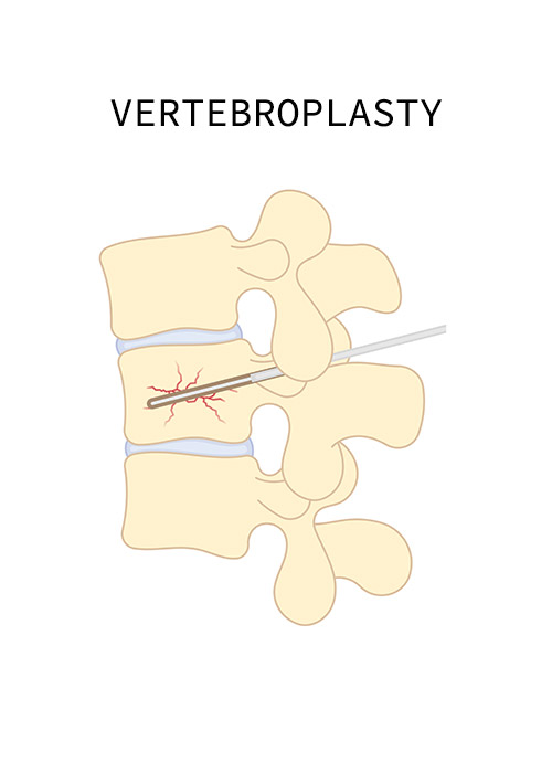 vertebroplasty-intro